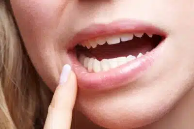 Aphtes : conseils pour soulager la douleur rapidement