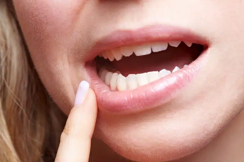 Aphtes : conseils pour soulager la douleur rapidement