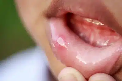 Comment soigner efficacement les aphtes