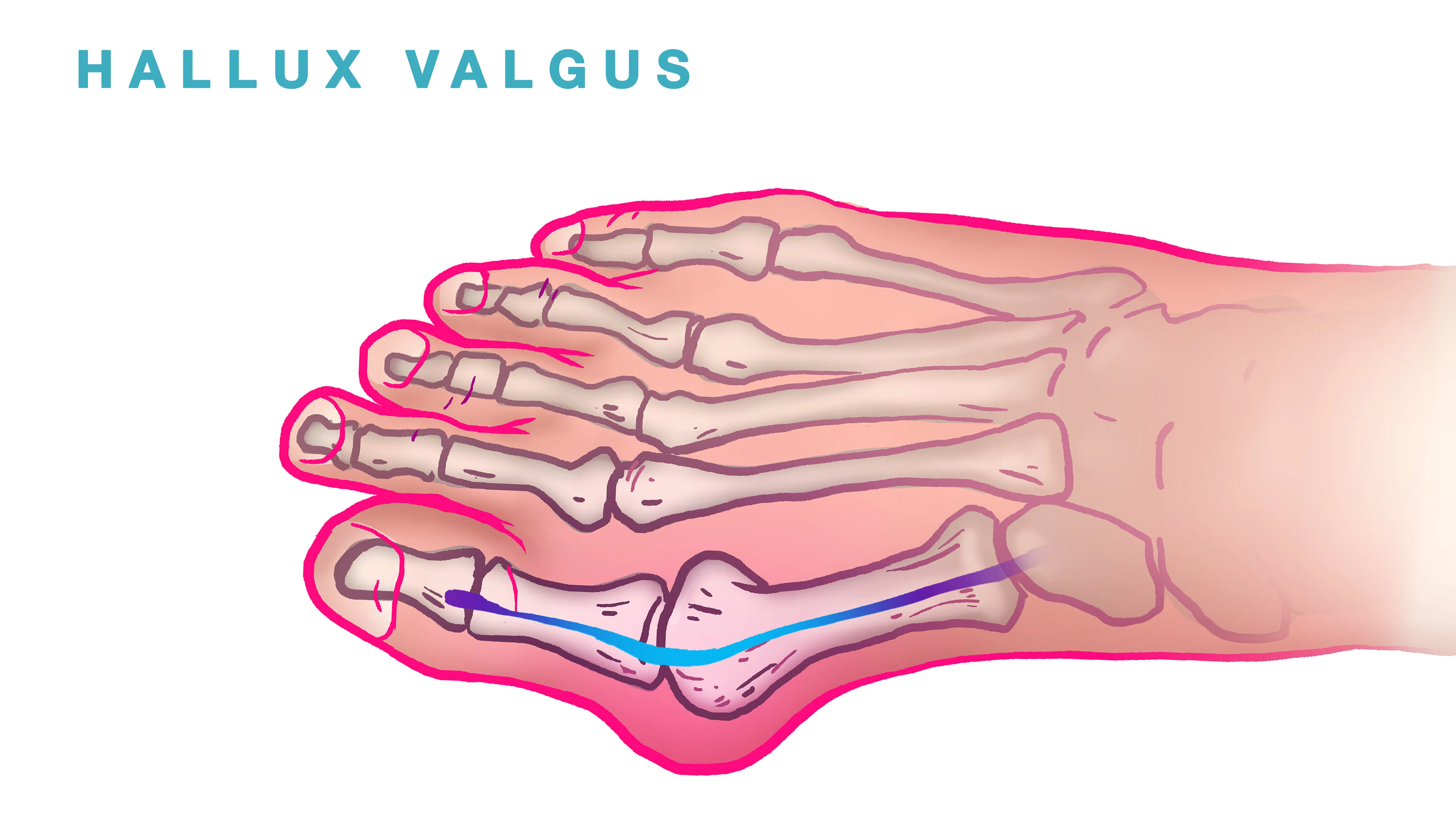 Hallux Valgus