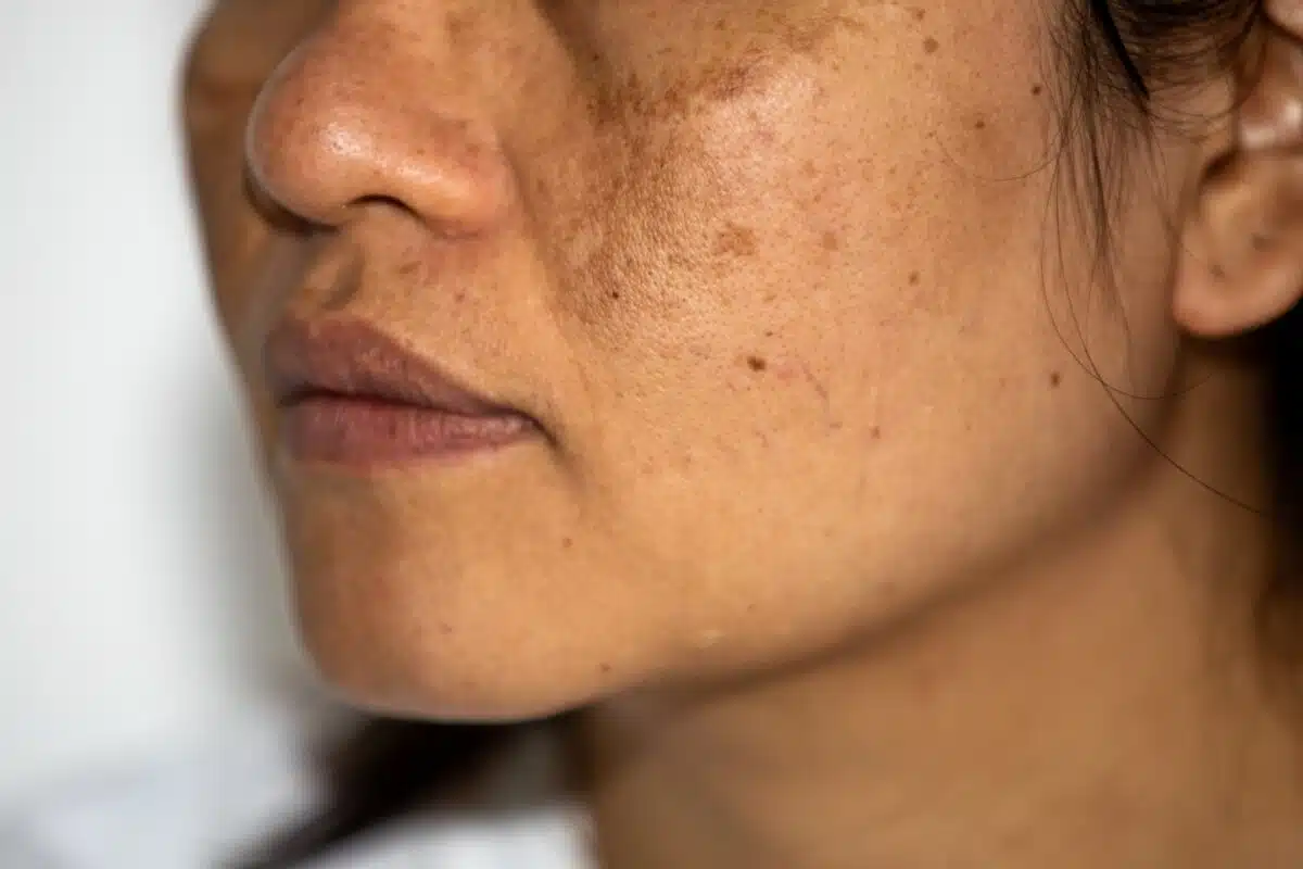 Les différentes formes d'hyperpigmentation : comprendre et agir