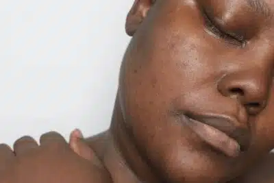 Les différentes formes d'hyperpigmentation : comprendre et agir