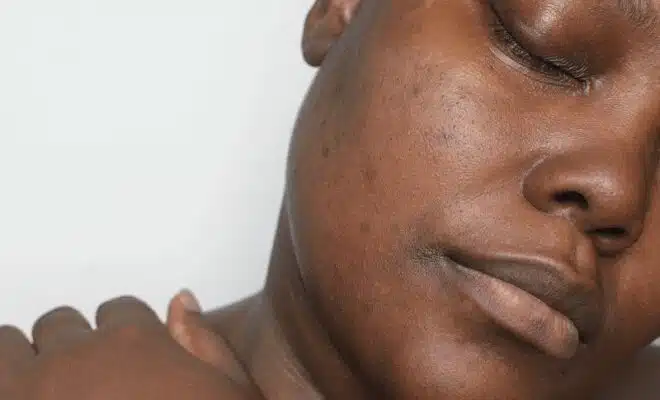 Les différentes formes d'hyperpigmentation : comprendre et agir