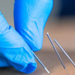 Comment l’acupuncture peut aider à rétablir l’équilibre du corps et de l’esprit ?